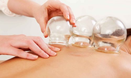 Exploring Cupping Therapy